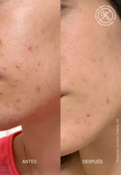 Transparent Lab Spezialpflege·Akne|